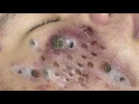 Every Day With Best Blackheads Videos 01