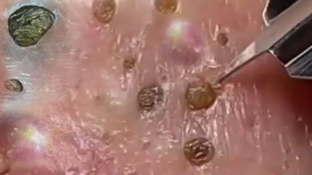 Every Day With Best Blackheads Videos 02