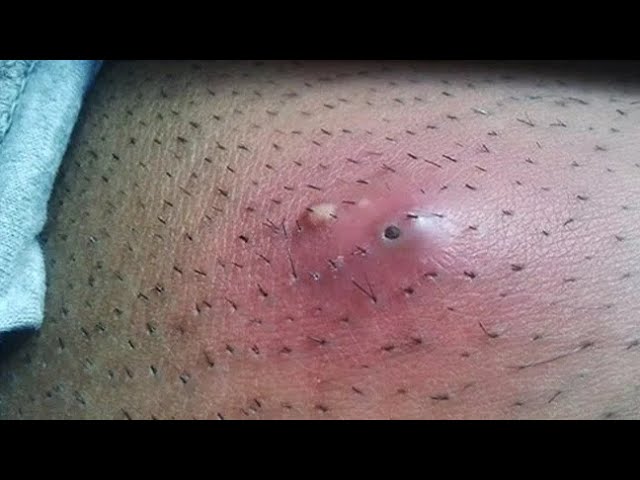 Every Day With Best Blackheads Videos 05